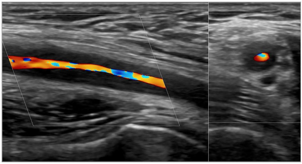 MASTERING VASCULAR ULTRASOUND Ultrasound in Polymyalgia Rheumatica (PMR) and Giant Cell Arteritis (GCA)