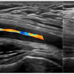 MASTERING VASCULAR ULTRASOUND Ultrasound in Polymyalgia Rheumatica (PMR) and Giant Cell Arteritis (GCA)