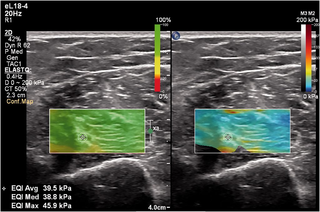 Musculosketetal elastography in athletic medicine:  from muscle to tendon injuries