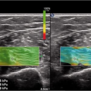 Musculosketetal elastography in athletic medicine:  from muscle to tendon injuries