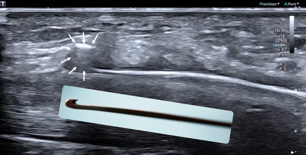 Ultrasound guided minimally invasive surgery in entrapment neuropathies