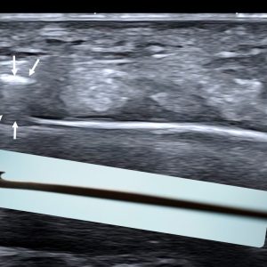 Ultrasound guided minimally invasive surgery in entrapment neuropathies